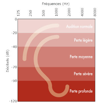 Degres-de-perte-auditive